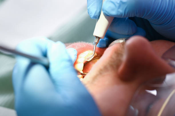 Best Emergency Tooth Extraction in Ben Lomond, CA