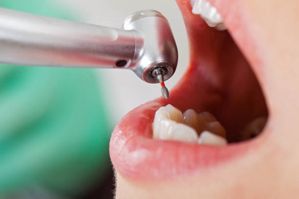 Best Emergency Wisdom Teeth Removal in Ben Lomond, CA